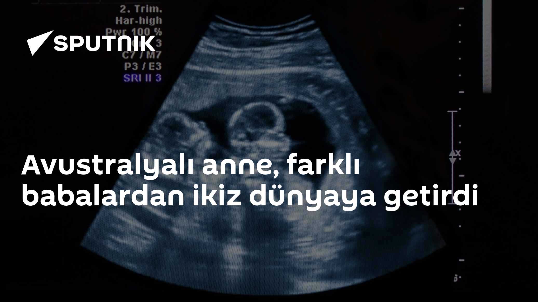 Avustralyalı anne, farklı babalardan ikiz dünyaya getirdi
