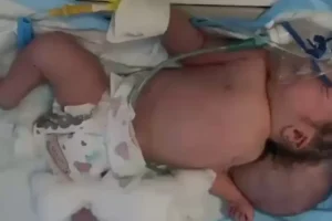 Irak'ta nadir görülen doğum vakası bildirildi