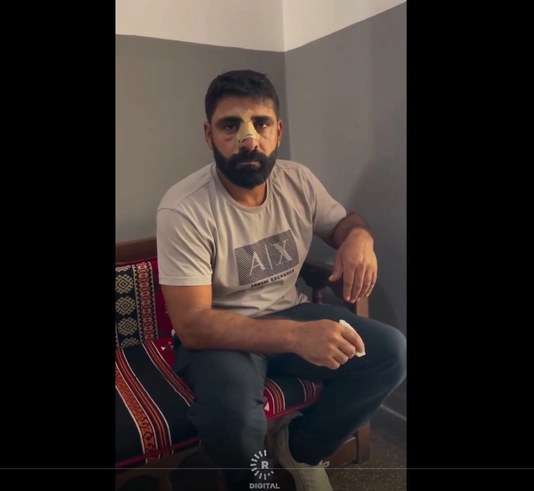 Bayburt’ta Amedspor forması gieyen Kürt inşaat işçilerini darp ettiler, burnu beş yerinden krıldı